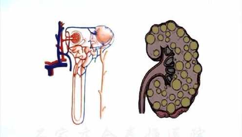 多囊肝多囊腎最新治療方法揭秘，小巷深處的秘密療法探索